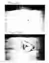 Fig. 04 - Awake airway, including two variants