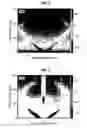 Fig. 03 - Removing vibration noise from seismic data obtained from towed seismic sensors