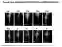 Fig. 64 - Gastric Retention and Controlled Release Delivery System