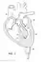 Fig. 04 - Visualization of a catheter viewed under ultrasound imaging