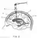 Fig. 02 - Central nervous system ultrasonic drain