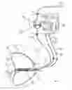 Fig. 02 - Gastro-esophageal reflux control system and pump