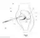 Fig. 06 - Device for guiding a drilling tool for forming a second bore in a bone