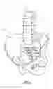 Fig. 02 - Sacral reconstruction fixation device