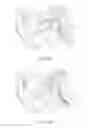 Fig. 15 - EUSTACHIAN TUBE TREATMENT SYSTEMS