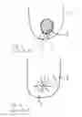 Fig. 02 - Implantable prosthesis for periareolar mastopexy