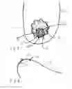 Fig. 05 - Implantable prosthesis for periareolar mastopexy