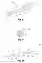 Fig. 05 - Methods for positioning a load-bearing component of an orthopedic implant device by inserting a malleable device that hardens in vivo