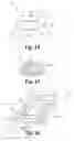 Fig. 07 - Methods for positioning a load-bearing component of an orthopedic implant device by inserting a malleable device that hardens in vivo