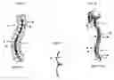 Fig. 02 - Methods and devices for correcting spinal deformities