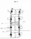 Fig. 12 - Methods and devices for correcting spinal deformities