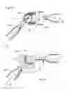 Fig. 50 - Articulating diamond-surfaced spinal implants