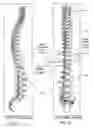 Fig. 55 - Articulating diamond-surfaced spinal implants
