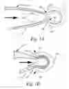 Fig. 02 - Reusable, Autoclaveable Closure Device for a Flexible Bag