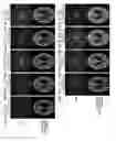 Fig. 06 - MRI data acquisition using propeller k-space data acquisition