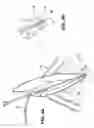 Fig. 05 - Apparatus for Evacuation of Root Canal