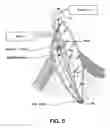 Fig. 06 - Apparatus for Evacuation of Root Canal