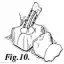 Fig. 10 - Apparatus for Evacuation of Root Canal