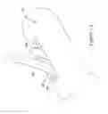 Fig. 03 - Method and apparatus for biliary access and stone retrieval