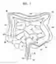 Fig. 02 - Advancement techniques for gastrointestinal tool with guiding element