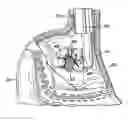 Fig. 01 - Anastomotic outlet revision