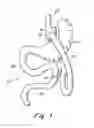Fig. 02 - Anastomotic outlet revision