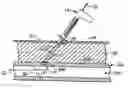 Fig. 01 - Blood vessel sealing system