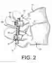 Fig. 03 - Spine stabilization system with dynamic screw
