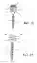 Fig. 12 - Spine stabilization system with dynamic screw
