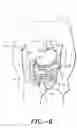 Fig. 07 - Gastric restriction method and system for treatment of eating disorders