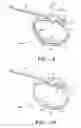 Fig. 08 - Gastric restriction method and system for treatment of eating disorders