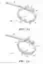 Fig. 09 - Gastric restriction method and system for treatment of eating disorders