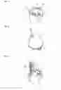 Fig. 02 - Waterproof hearing aid