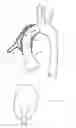 Fig. 02 - Heart assist device utilising aortic deformation