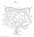 Fig. 02 - Gastrointestinal tool over guiding element