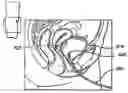Fig. 01 - Non-Occlusive, Laterally-Constrained Injection Device