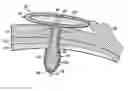 Fig. 01 - Device for delivery of an agent to the eye and other sites