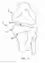 Fig. 02 - Method and apparatus for performing an open wedge, high tibial osteotomy