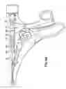 Fig. 07 - Endoscopic Threaded Clip