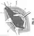 Fig. 09 - Absorbable fastener and applying apparatus