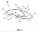Fig. 05 - Bioabsorbable occlusion device