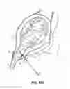 Fig. 20 - Neurostimulation system