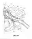 Fig. 22 - Neurostimulation system