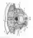 Fig. 44 - Neurostimulation system