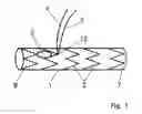 Fig. 02 - Stent prosthesis for vascular surgery in particular in the area of the aortic arch