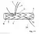 Fig. 06 - Stent prosthesis for vascular surgery in particular in the area of the aortic arch