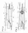 Fig. 03 - SHORT WIRE STENT DELIVERY SYSTEM WITH SPLITTABLE OUTER SHEATH