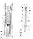 Fig. 04 - SHORT WIRE STENT DELIVERY SYSTEM WITH SPLITTABLE OUTER SHEATH