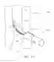 Fig. 10 - Surgical stapling device with a curved cutting member