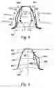 Fig. 03 - Surface compression of a toothed section